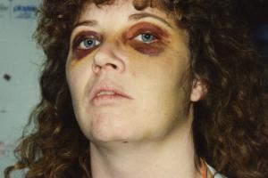 Woman with bruised eyes