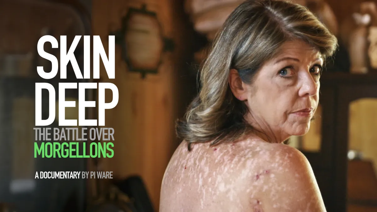 A middle aged White woman stares back at us, her back covered in skin discolorations.