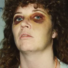 Woman with bruised eyes